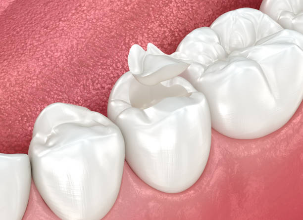 Best Dental Inlays and Onlays  in Warner Robins, GA